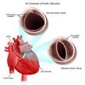 Aortic Stenosis - Symptoms, Causes, Treatment, Surgery