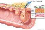 What is colorectal cancer?