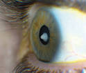 Blink: Postoperative Blood Clotting Near Schlemm's Canal