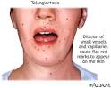 Telangiectasia -