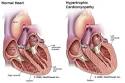 Hypertrophic Cardiomyopathy