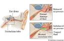  Eustachian Tubes : Healthwise Medical Information on e Medicine Health