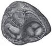 Aortic valve replacement - Wikipedia, the free encyclopedia