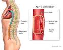 Dissecting Aortic Aneurysm