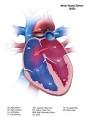 CDC - Congenital <b>Heart Defects</b>, Facts about <b>Atrial Septal Defect</b>