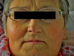Mitral <b>facies</b> is one of the