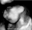 ANENCEPHALY3d.jpg