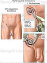 Right Inguinal Orchiectomy - Medical Illustration, Human Anatomy ...