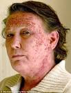 a severe allergic reaction