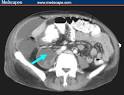 <b>Psoas abscess</b> (blue arrow),