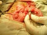 <b>Appendicitis</b> in Survival Situations | Doom and Bloom (