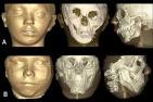 Fig 3. 3D virtual models of 2