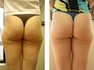 Houston Mesotherapy Non Surgical Cellulite Reduction   Meso