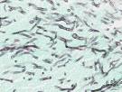 File:Pulmonary aspergillosis (2) invasive type.jpg - Wikipedia ...
