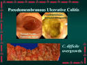 Clostridium difficile- Pathology