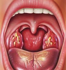 angina