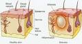 An external <b>abscess</b> is an