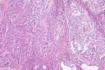 File:<b>Myoepithelioma</b> - intermed