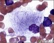Gaucher's Disease: MedlinePlus
