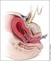 of <b>Postpartum Hemorrhage</b>