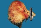 File:Uterine carcinosarcoma.jpg - Wikipedia, the free encyclopedia