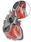 Mitral Valve Prolapse (MVP): Disease - Stenosis - Insufficiency