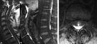 <b>spinal subdural hematoma</b>