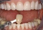 Dental Bleaching + Whitening in San Antonio