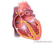 <b>Catheter Ablation</b>