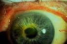 Photos for <b>Herpes Zoster</b>
