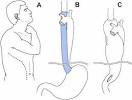 Transhiatal Esophagectomy (THE) - University of Michigan Thoracic ...