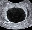 The Fetal Medicine Centre / Viability scan