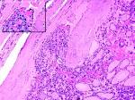 in <b>follicular carcinoma</b>