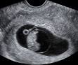 The Fetal Medicine Centre / Viability scan