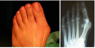 Best Walking Shoes For Bunions