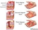 Burns: MedlinePlus Medical Encyclopedia Image