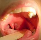 Early Left <b>Peritonsillar</b>