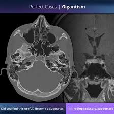 Image result for Gigantism MRI