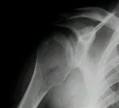 <b>Tumor</b> de <b>células gigantes</b>: