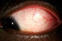 Erythema Multiforme: 22 year-old male with a persistent red eye ...