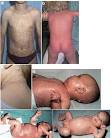<b>ichthyosiform erythroderma</b>