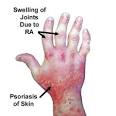 of <b>psoriatic arthritis</b>?