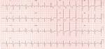 <b>Right ventricular hypertrophy</b>