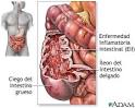La <b>enfermedad</b> de Crohn es una