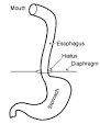 Transhiatal Esophagectomy (THE) - University of Michigan Thoracic ...