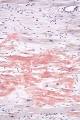 230px-Cardiac_amyloidosis_high ...