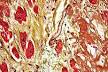 Cardiovascular disease - Wikipedia, the free encyclopedia