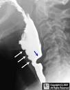 LearningRadiology - Cricopharyngeus, cricopharyngeal, spasm ...
