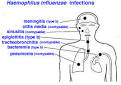 Haemophilus influenzae