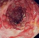 Rapid Growing <b>Colonic</b> Nk/T